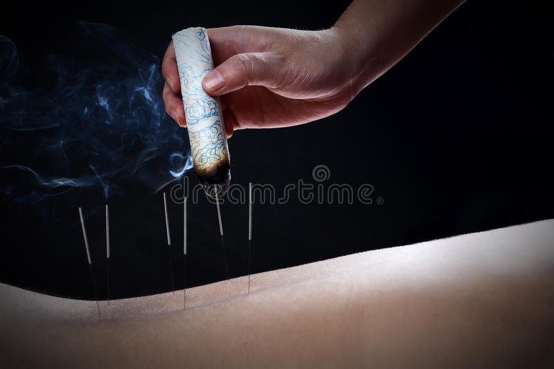 This image has an empty alt attribute; its file name is acupuncture-moxibustion-traditional-chinese-medicine-method-therapy-form-alternative-image-www.sunblestproducts.com_.jpg